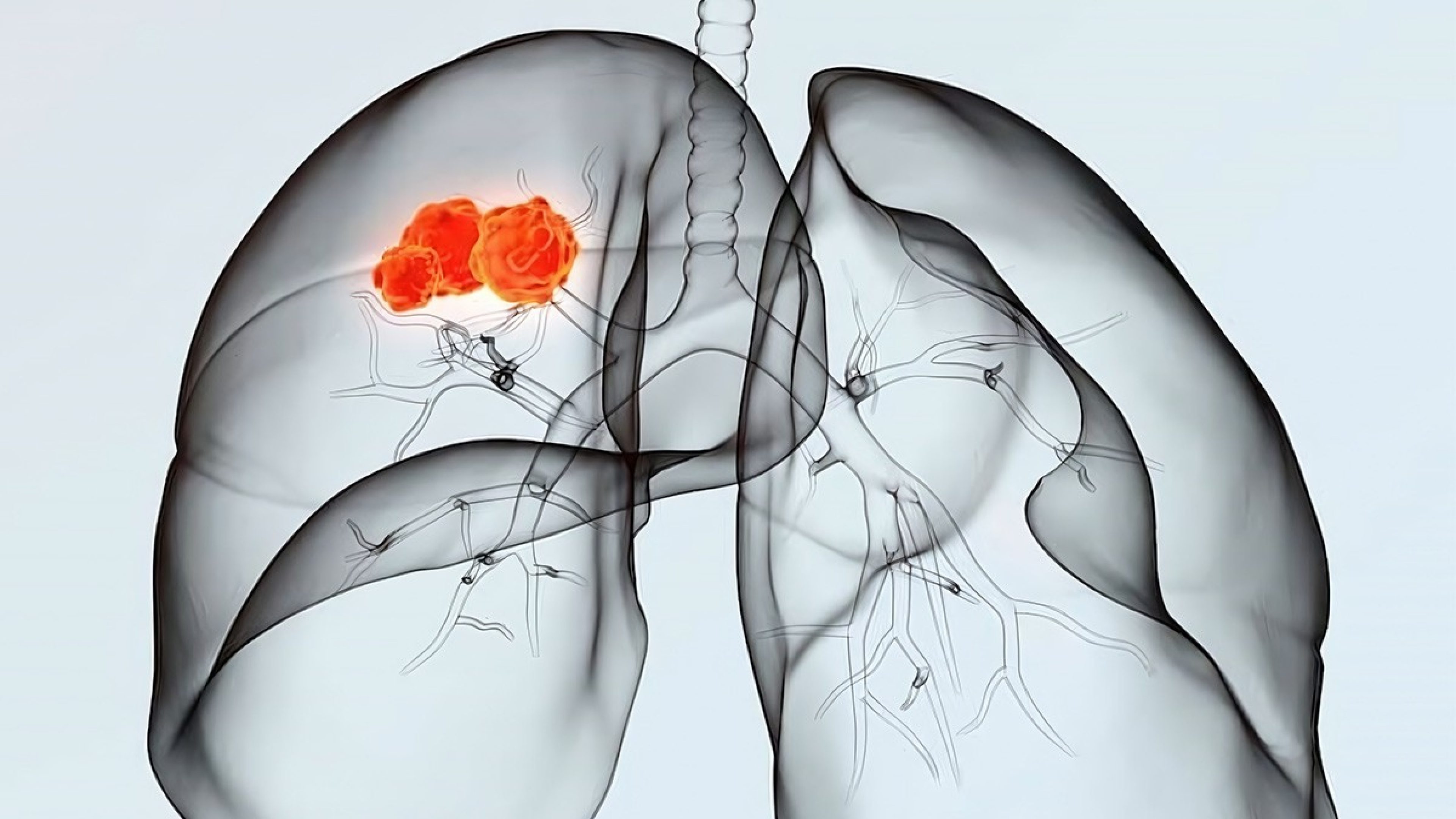Lunge mit Krebszellen